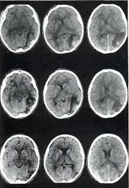 Ct din imaginile creierului de diferite patologii