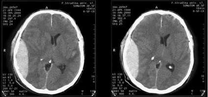 Ct din imaginile creierului de diferite patologii