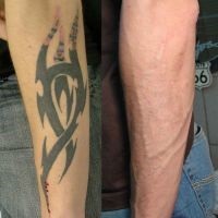 Laser Tattoo Removal