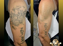 Laser Tattoo Removal - studio de tatuaj alb de șoim