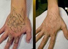 Lézeres tetoválás eltávolítás - tetováló stúdió fehér sólyom