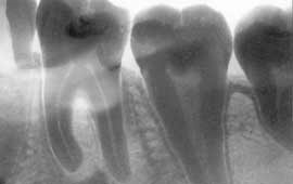 Tratamentul parodontitei inter-rădăcină perforată cronică a unui dinte multi-rădăcină