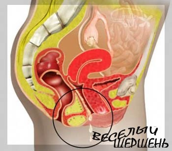 Krónikus prostatitis kezelése mézzel