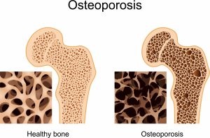 Medicamentele pentru osteoporoza sunt cele mai eficiente bifosfonați, raloxifen, teriparadit, preparate de calciu