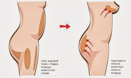 Lipofilling arc és a test - minden előnyét műtét lipoplasty, teljesítmény technika, tanácsadás