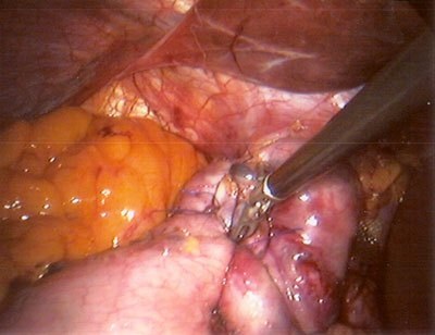 Tratamentul chirurgical minim invaziv (laparoscopic) al herniei de deschidere a diafragmei esofagiene