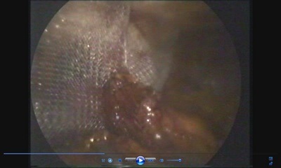 Tratamentul chirurgical minim invaziv (laparoscopic) al herniei de deschidere a diafragmei esofagiene