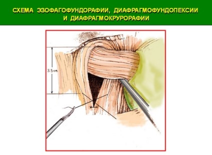 Tratamentul chirurgical minim invaziv (laparoscopic) al herniei de deschidere a diafragmei esofagiene