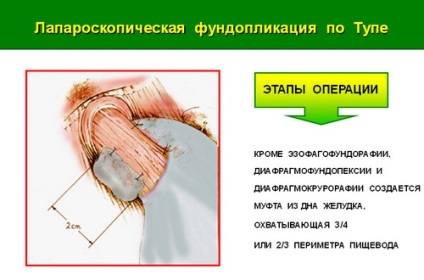 Tratamentul chirurgical minim invaziv (laparoscopic) al herniei de deschidere a diafragmei esofagiene