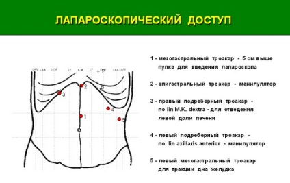 Tratamentul chirurgical minim invaziv (laparoscopic) al herniei de deschidere a diafragmei esofagiene