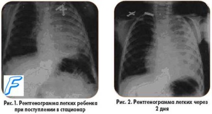 Pneumonie masivă