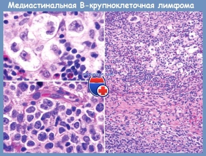 Mediastinal (timus) în limfom cu celule mari - diagnostic, tratament