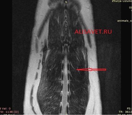Myelopathia a fibro-pórusos embólia és a gerincvelő infarktus következtében (fhe)