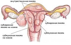 Myoma de uter - tratament, simptome, cauze