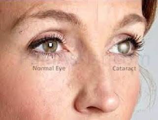 Este posibilă vindecarea cataractei ambilor ochi, a bolilor oculare
