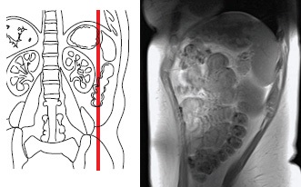 MRI képalkotás a hasüreg töltések kenuk, Avitsena 1