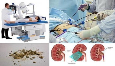 Chirurgie pentru îndepărtarea pietrelor la rinichi