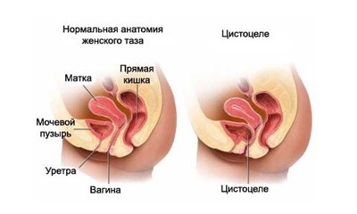 Omisiunea vezicii urinare la simptomele și cauzele femeilor
