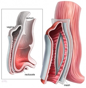 Omiterea pereților vaginului și a uterului (prolapsul organelor genitale), Korzhuev sergei Igorevich
