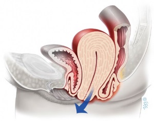 Omiterea pereților vaginului și a uterului (prolapsul organelor genitale), Korzhuev sergei Igorevich