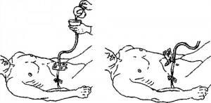 Caracteristici de îngrijire pentru gastrostomie, totul despre stoma