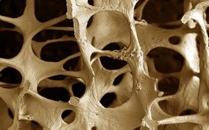 Diagnosticul și tratamentul osteoporozei scheletice