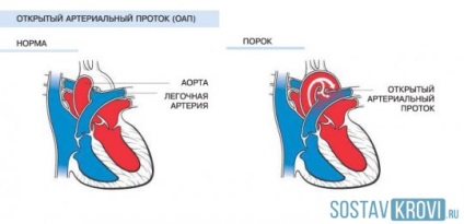 Open ductul arterial la copii, nou-născuți, adulți, decât tratament periculos