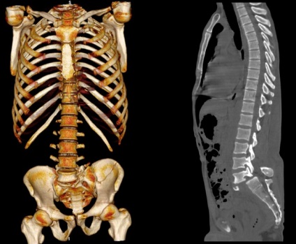 Fractura procesului transversal al vertebrelor (coloanei vertebrale), efecte, tratament