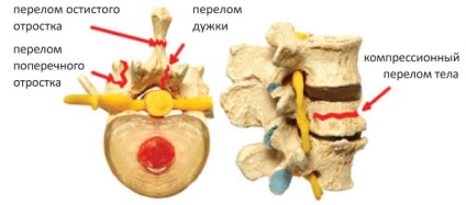 Fractura procesului transversal al vertebrelor (coloanei vertebrale), efecte, tratament