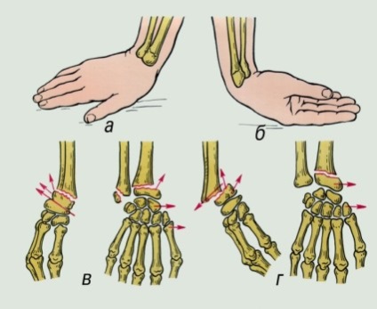 Fractura brațului cu simptome de deplasare și asistență medicală