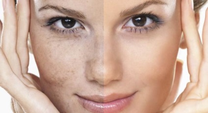 Pigmentarea pielii de ce apare și cum să scapi de sănătate