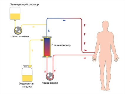 Plasmafereza, purificarea și purificarea sângelui