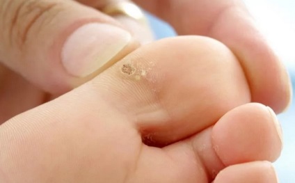 A talpi szemölcs az ujját okozza a lábak, jellemzői, kezelése