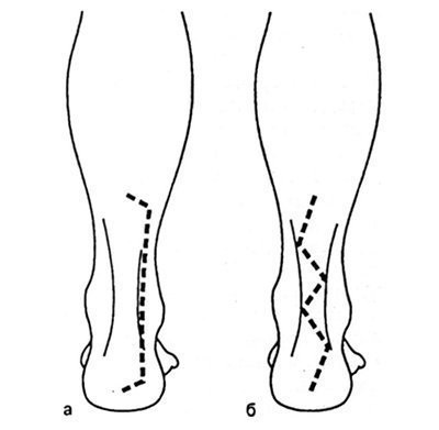 Deteriorarea tendonului calcaneal (Achilles)