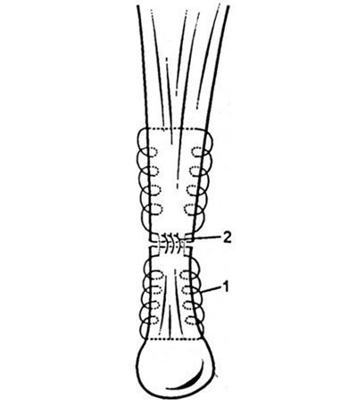 Deteriorarea tendonului calcaneal (Achilles)