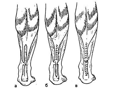 Deteriorarea tendonului calcaneal (Achilles)