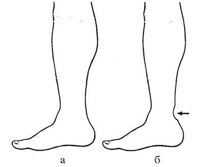 Deteriorarea tendonului calcaneal (Achilles)