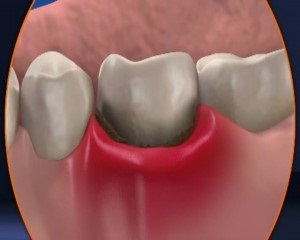 Készítmények a periodontális betegség kezelésére és a periodontitis