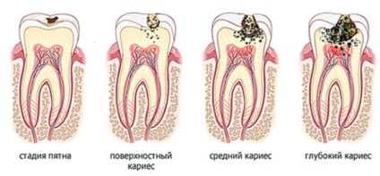 Cauzele cariilor dentare