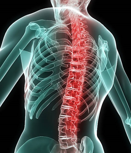 Prevenirea complicațiilor de osteochondroză, viață cu dureri de spate scăzute