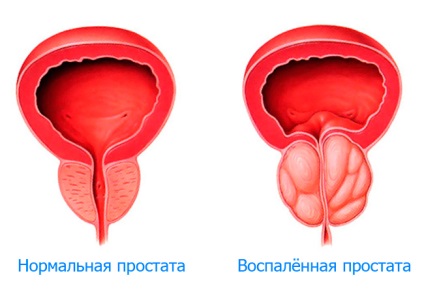 Prostatita cauzează, simptome și semne, tratament