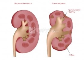 Prostatita cauzează, simptome și semne, tratament