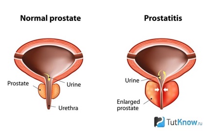 prostatita semne