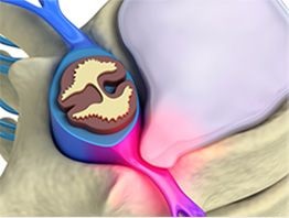 Protruzia discurilor intervertebrale ale coloanei vertebrale - tratament, semne, simptome