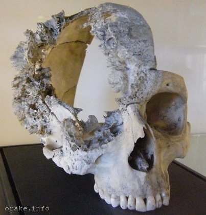 Rák Skull tünetek, kezelés, prognózis, fotók