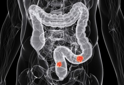 Cancerul de colon are primele semne și simptome în stadiile incipiente