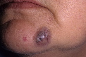 Cancer de piele metastatic