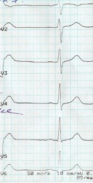 Decodarea intervalului eq qt - sistol electric ventricular