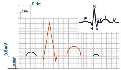 Megfejtése EKG intervallum qt - elektromos kamrai szisztolés