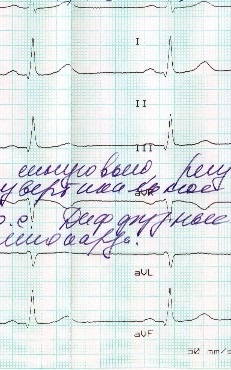 Megfejtése EKG intervallum qt - elektromos kamrai szisztolés